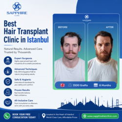 Why Sapphire Hair Clinic Is Considered the Best Hair Transplant Clinic in Istanbul