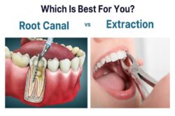 Root Canal vs. Tooth Extraction: Which Is the Better Choice?